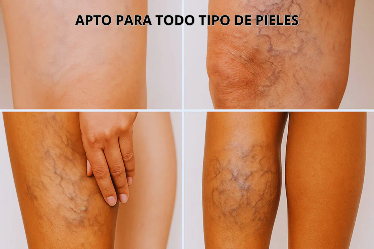 Parches Naturales para Varices y para las Piernas Cansadas - VeinPatch™