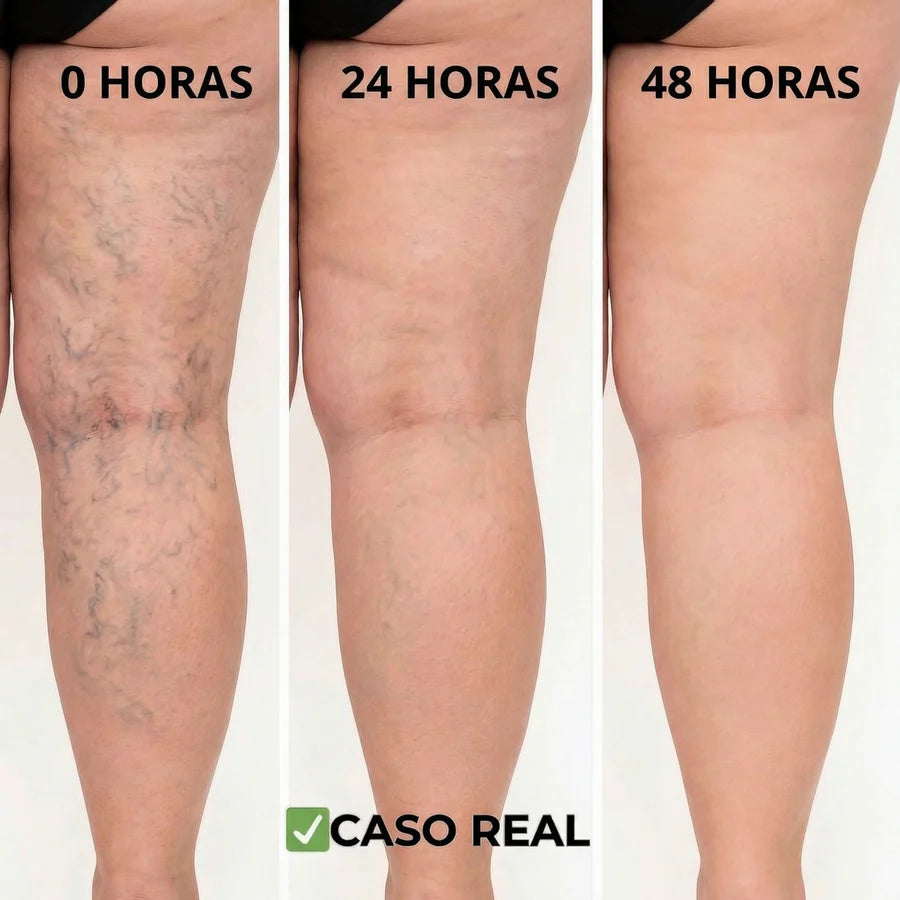 Parches Naturales para Varices y para las Piernas Cansadas - VeinPatch™
