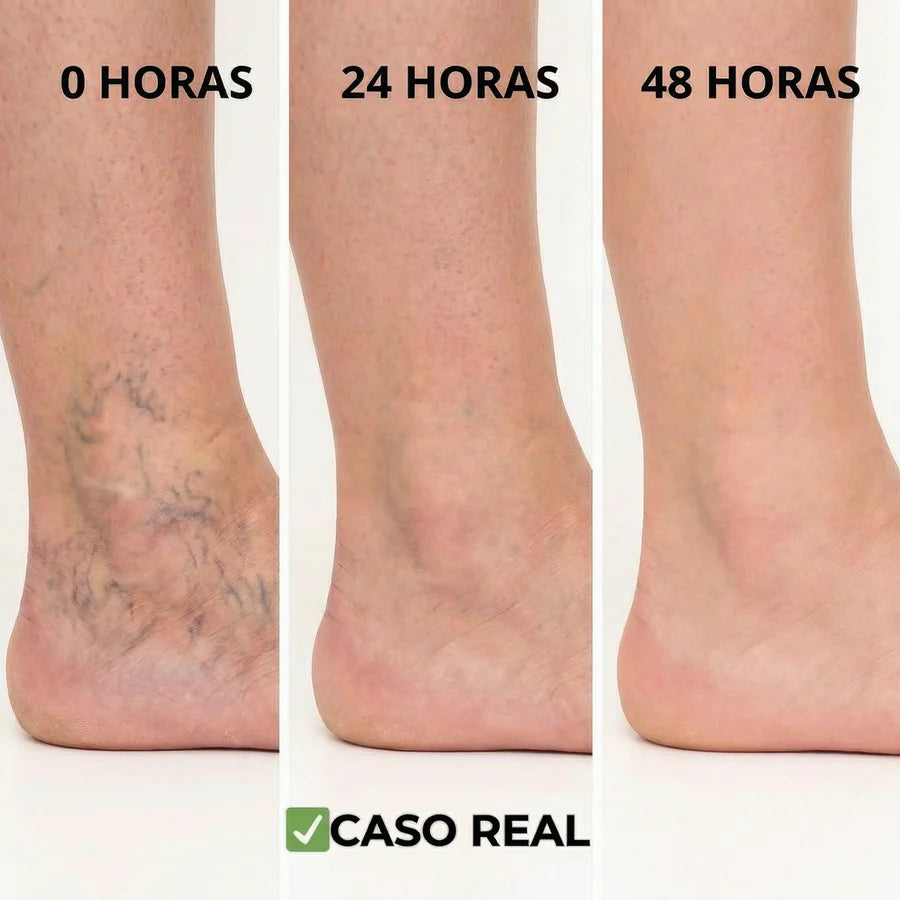 Parches Naturales para Varices y para las Piernas Cansadas - VeinPatch™